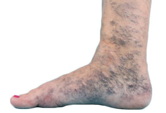 Krampfadern an den Beinen